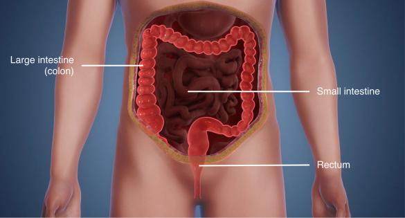 Colon cancer refers to cancer in the colon and/or rectum, or both.