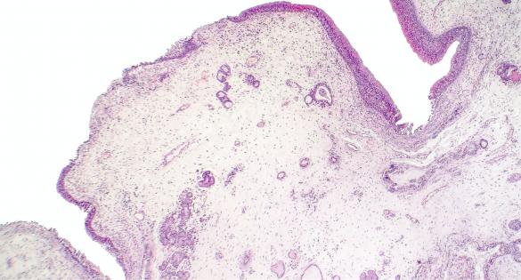 Hyperplastic polyps and inflammatory polyps