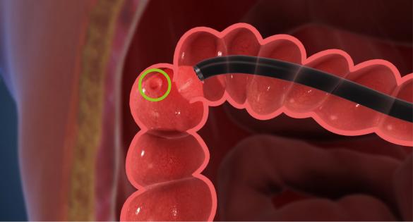 La mayoría de los cánceres de colon comienzan como un crecimiento en el revestimiento interior del colon o del recto.
