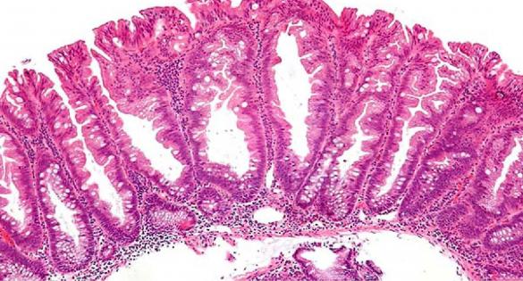 Sessile serrated polyps (SSP) and traditional serrated adenomas (TSA)